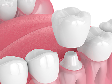 Elegant Dental Arts | TMJ Disorders, Preventative Program and Implant Dentistry