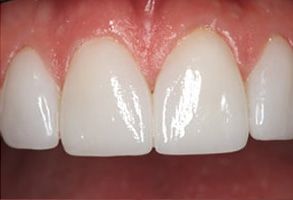 Elegant Dental Arts | Ceramic Crowns, Pediatric Dentistry and Botox reg 